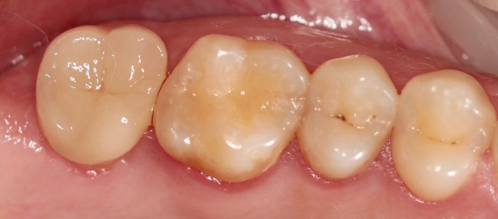 Пересаженные зубы