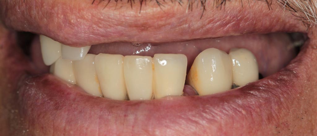 Протезирование зубов до лечения